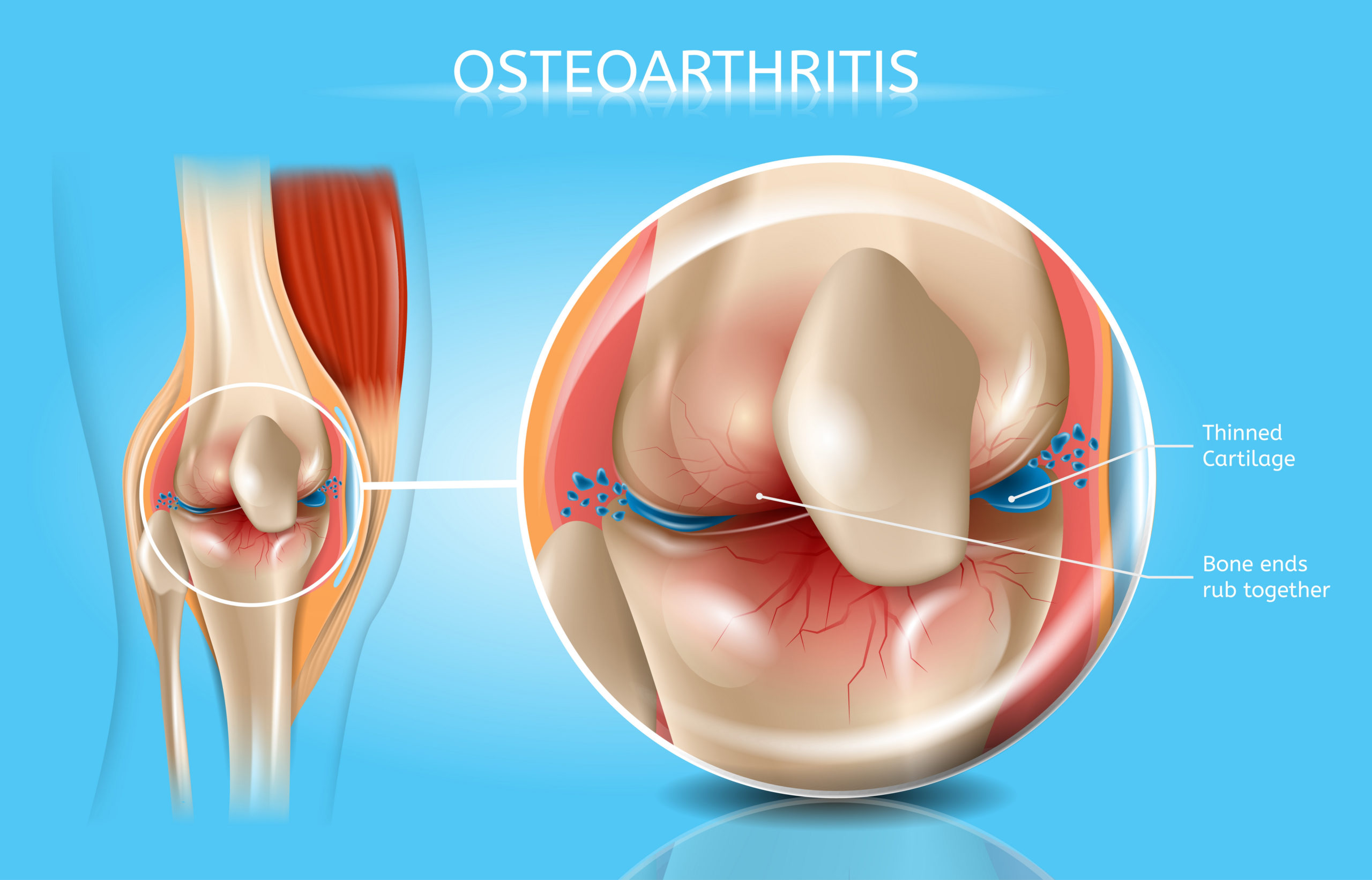 Join pain  Osteoarthritis